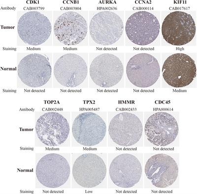 Bioinformatics Analysis of Candidate Genes and Pathways Related to Hepatocellular Carcinoma in China: A Study Based on Public Databases